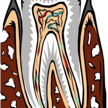 Root canal treatment