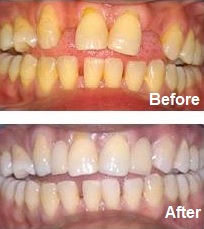 Adhesive bridge after photo showing replaced front tooth