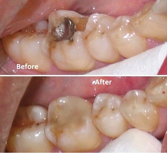 Before and after cavity filling with dental bonding