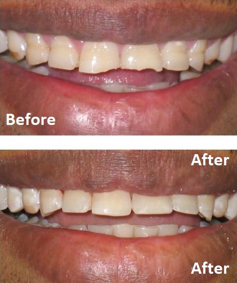Chipped or worn teeth repaired with dental bonding