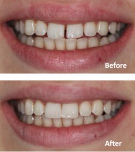 Before and after closing gap between teeth
