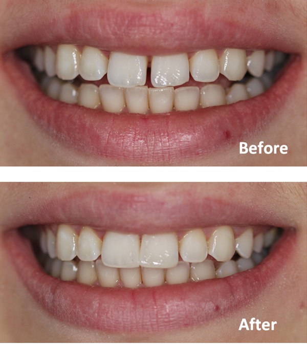 Before and after closing gap between teeth with composite bonding