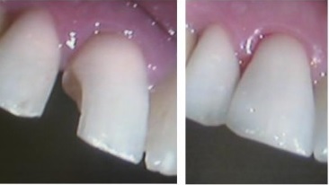 Before and after chipped tooth repair with dental bonding
