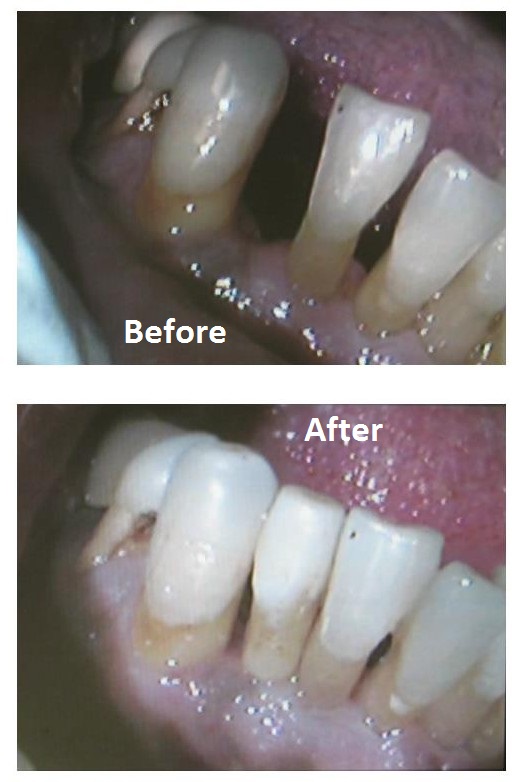 Tooth replacement by a dental bridge