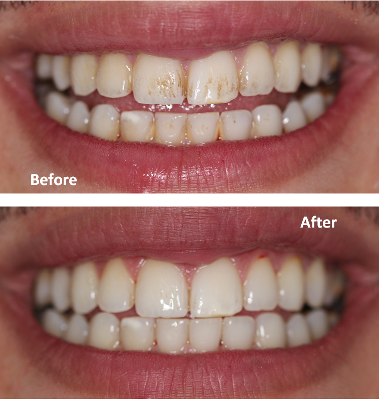Professionally cleaned teeth