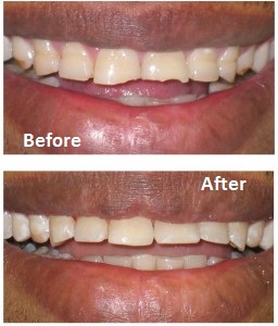 Before and after repair teeth with composite bonding