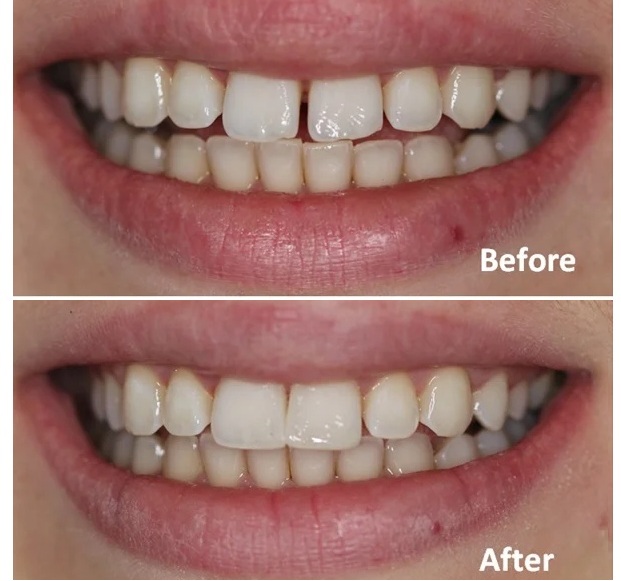 Repaired worn teeth with dental composite bonding
