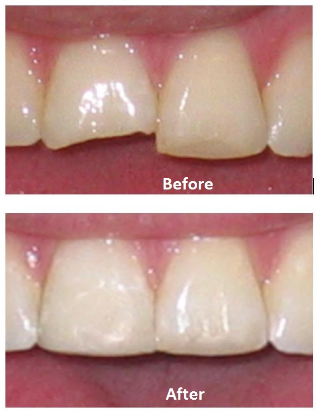 Before and after repairing chipped tooth edges