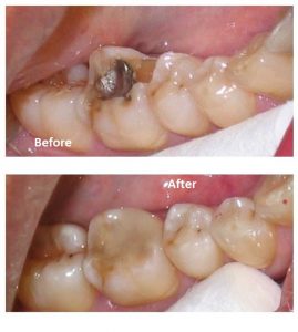 Before and after repairing decayed tooth
