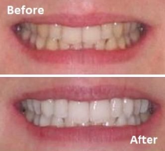 Teeth whitening before and after