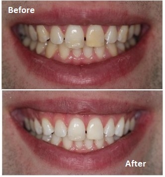 Teeth whitening before and after