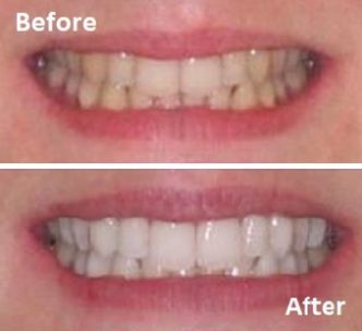 Teeth whitening result 1