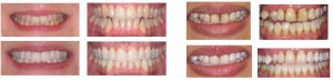 Professional Teeth Whitening