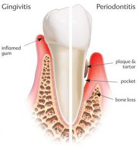 dental hygiene services for gum disease