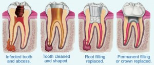 root canal treatment