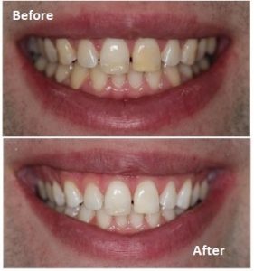 professional teeth whitening dentist ealing