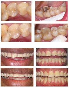 white fillings