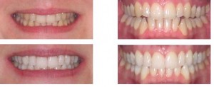teeth whitening at dentael