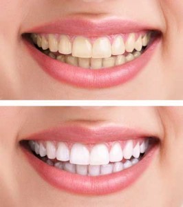 Teeth Whitening at Greenford Dentist