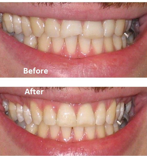 Repair chipped fron tooth dentist | dentael