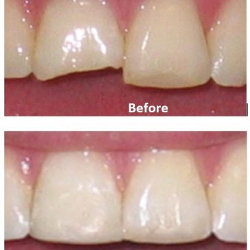 Chipped Tooth Repair
