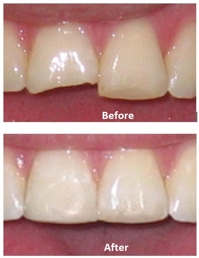 Repair chipped front tooth