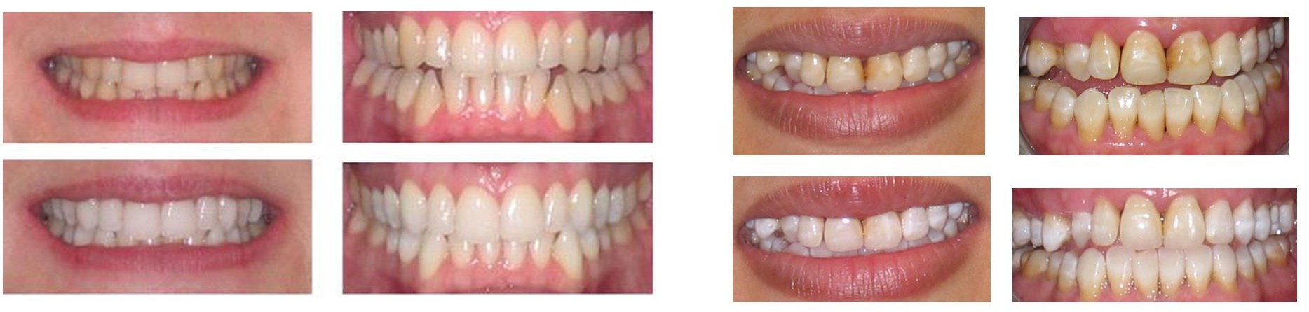 Teeth Whitening Dentist Southall