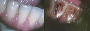 dental hygienist teeth cleaning ealing