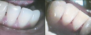 teeth cleaning greenford hygienist