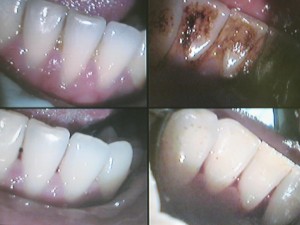 Teeth cleaning ealing | dentael