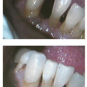 Dental Bridge to Replace Missing Tooth