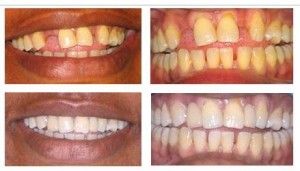 cosmetic dentistry ealing - adhesive bridges