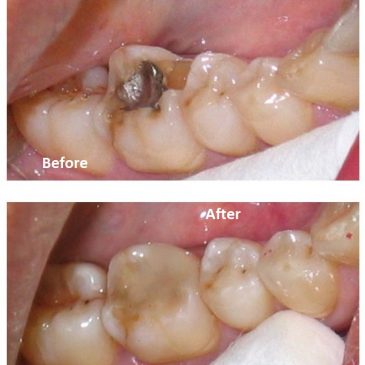Dental Bonding in Ealing Explained