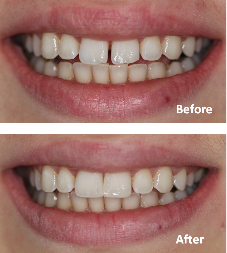 Close gap between teeth without braces – Affordable cosmetic dentistry in Ealing by dentael dentist