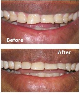 Repaired worn teeth - dentael dentist