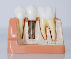 dental impants