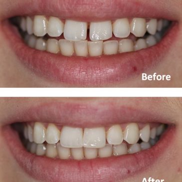 How to Close a Gap Between Teeth