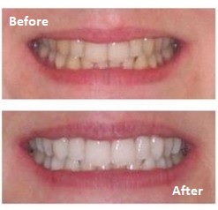 teeth whitening dentist greenford