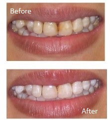 teeth whitening dentist southall 1
