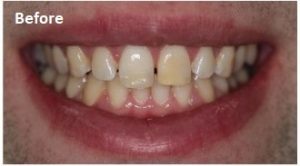 teeth whitening ealing