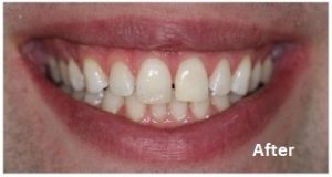 teeth whitening greenford
