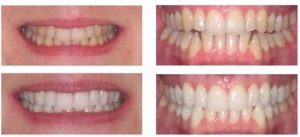 teeth whitening dentist near me