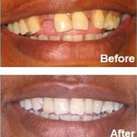 adhesive bridge dental