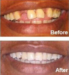 adhesive bridge dental