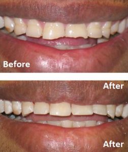 dental composite bonding greenford
