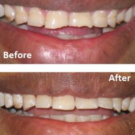 dental composite bonding greenford