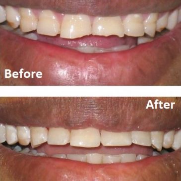 What Is Dental Composite Bonding?