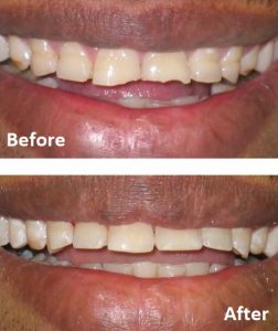 dental composite bonding ealing tooth repair