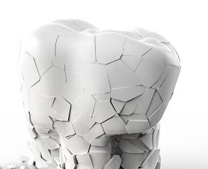 tooth erosion treatments dentist