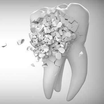 Tooth Erosion Causes & Treatments